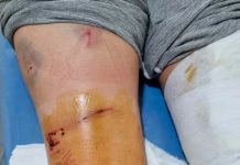 Una mujer fue atacada por una jauría de perros en Pilar y tiene heridas en todo su cuerpo